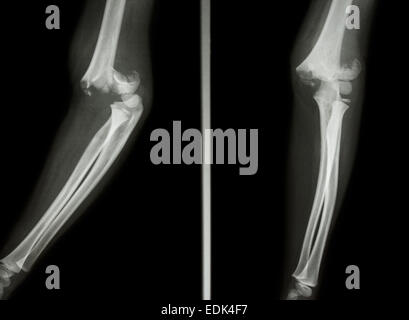 Film X-ray show a gomito Supracondylar omero frattura Foto Stock