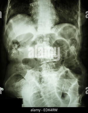 Film X-ray addome supino mostra piccolo intestino dilatato ed aria nel piccolo intestino a causa di piccole occlusione intestinale Foto Stock