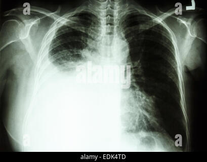 Film i raggi X al torace PA montante : mostra di versamento pleurico a destra del polmone a causa di cancro ai polmoni Foto Stock