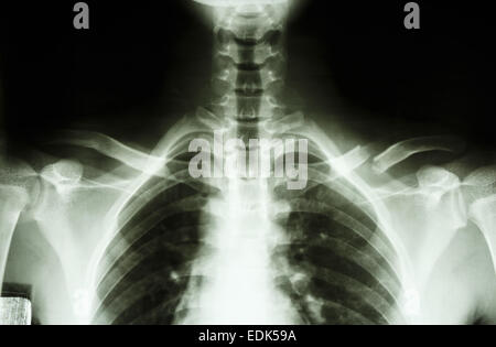 Film X-ray show frattura completa medio 1/3 clavicola sinistra Foto Stock