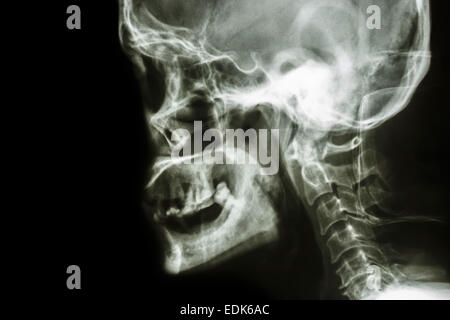 Film x-ray laterale del cranio : mostra umano normale del cranio e la zona vuota a sinistra Foto Stock