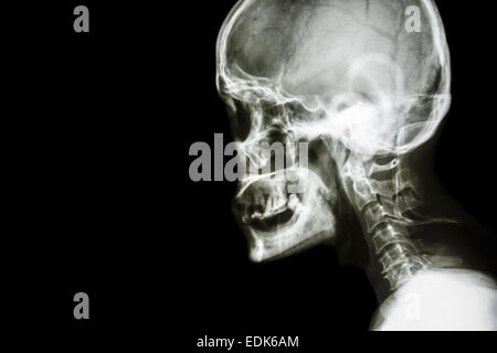 Film x-ray laterale del cranio : mostra umano normale del cranio e della colonna vertebrale cervicale e la zona vuota a sinistra Foto Stock