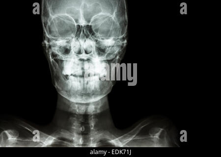 Film x-ray cranio AP : mostra umano normale del cranio e la zona vuota a destra Foto Stock