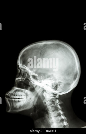 Film x-ray laterale del cranio : prova di umana del cranio e la zona vuota sul lato superiore per riempire il testo Foto Stock
