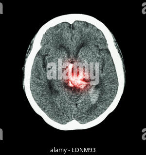 Scansione TC del cervello : mostra ictus emorragico Foto Stock