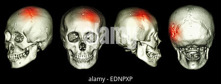 Scansione TAC del cranio umano e 3D con corsa (accidente cerebrovascolare) Foto Stock