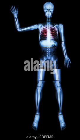 Stop TB(La tubercolosi) (osso umano di alzare la mano) (corpo intero :testa collo cranio colonna vertebrale spalla gomito del braccio avambraccio polso mano dito t Foto Stock
