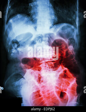 Piccola ostruzione intestinale. Film X-ray addome supino : Mostra del piccolo intestino dilatato a causa di piccole occlusione intestinale Foto Stock
