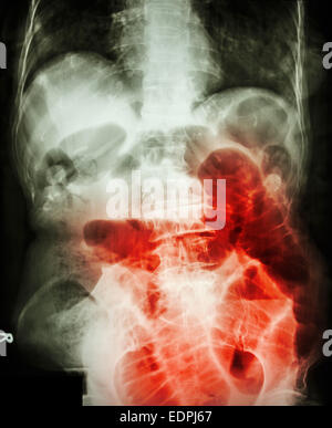Piccola ostruzione intestinale. Film X-ray addome supino : Mostra del piccolo intestino dilatato a causa di piccole occlusione intestinale Foto Stock