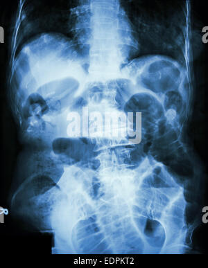 Piccola ostruzione intestinale. Film X-ray addome supino : Mostra del piccolo intestino dilatato a causa di piccole occlusione intestinale Foto Stock
