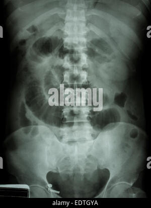 'Small ostruzione intestinale' film X-ray addome supino : visualizza il piccolo intestino dilatare Foto Stock
