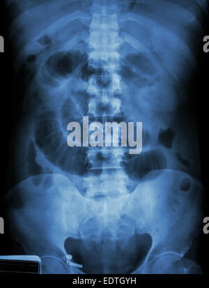 'Small ostruzione intestinale' film X-ray addome supino : visualizza il piccolo intestino dilatare Foto Stock