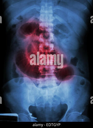 'Small ostruzione intestinale' film X-ray addome supino : visualizza il piccolo intestino dilatare Foto Stock