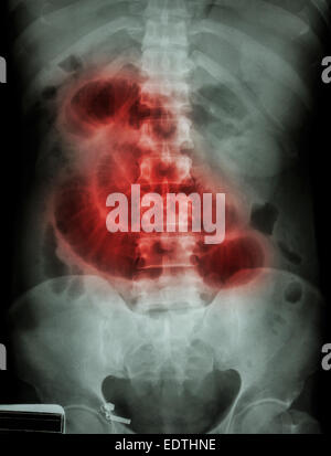 'Small ostruzione intestinale' film X-ray addome supino : visualizza il piccolo intestino dilatare Foto Stock