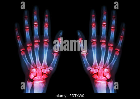 Più comune di artrite entrambe le mani ( Gotta , Artrite ) su sfondo nero Foto Stock
