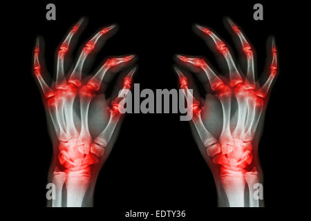 Più comune di artrite entrambe le mani per adulti ( Gotta , Artrite ) su sfondo nero Foto Stock