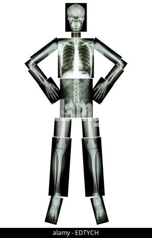 Un osso umano di stand e akimbo (X-ray tutto il corpo : testa collo cranio colonna vertebrale spalla gomito del braccio avambraccio polso mano dito torace torace Foto Stock