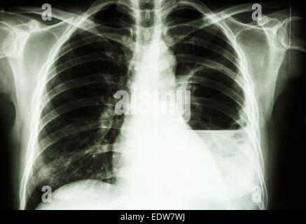 Film X-ray show polmone sinistro ascesso da Burkholderia pseudomallei infezione (Mellioidosis) Foto Stock