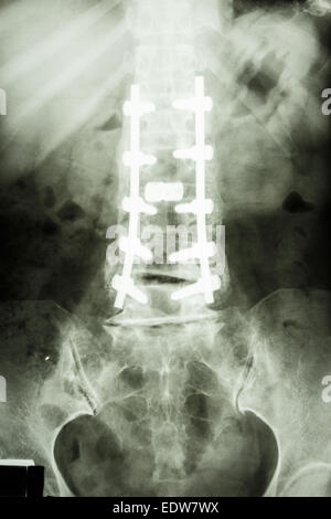 Film X-ray show della colonna vertebrale lombare con vite peduncolare fissaggio nel paziente spondylolithesis Foto Stock