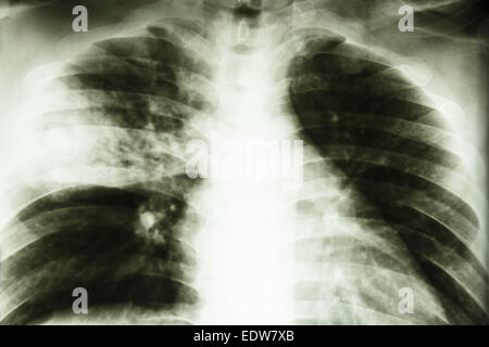 Film X-ray show lacunose infiltrarsi a medio destro polmone (Lobar polmonite)da infezione da Mycobacterium tuberculosis (vasca polmonare Foto Stock