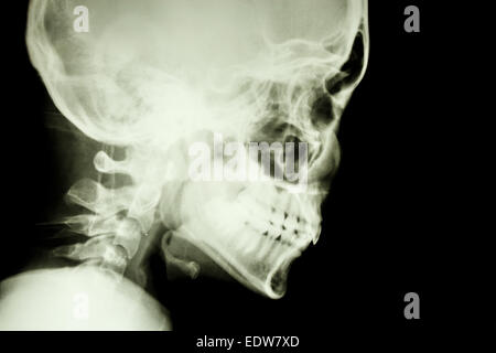 Film X-ray show normale del cranio e della colonna vertebrale cervicale in parte laterale (isolato) Foto Stock