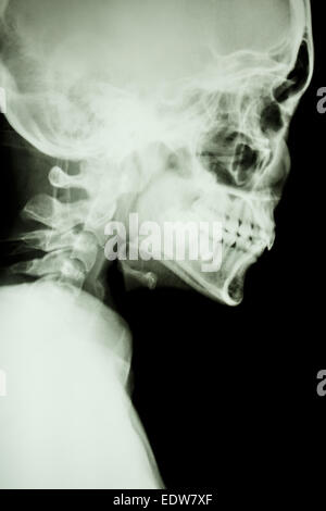 Film X-ray show normale del cranio e della colonna vertebrale cervicale in parte laterale (isolato) Foto Stock