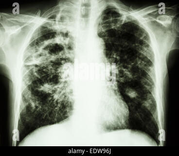 Film i raggi x al torace mostra la cavità al polmone destro,fibrosi interstiziale & & patchy infiltrarsi in corrispondenza di entrambi i polmoni a causa di Mycobacterium tubercu Foto Stock