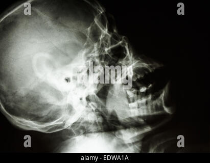 Cranio di pellicola laterali e verso l'alto mostra umano normale del cranio e la zona vuota a destra Foto Stock