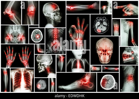 X-ray più parte dell'umana con malattia multipli (corsa, artrite, gotta, artrite, tumore al cervello, osteoartrite, etc) Foto Stock