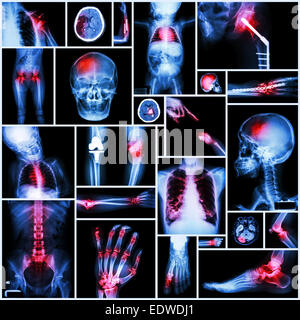 Raccolta di raggi X più parte dell'umana,operazione ortopedica e malattia multipli (spalla lussazione,CP,frattura,Gotta, Foto Stock