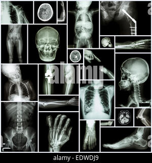 Collezione X-ray 'Multiple parte dell' umano ,"di chirurgia ortopedica' e 'Multiple malattia" (frattura,lussazione di spalla,Osteoarthr Foto Stock