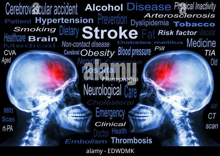 X-ray cranio con 'Stroke' e Medico testo Foto Stock