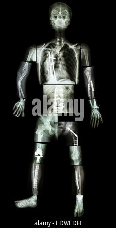Lo scheletro umano e la frattura multipla. Egli è stato operato e fisso interno dalla piastra e vite a sito multiplo Foto Stock