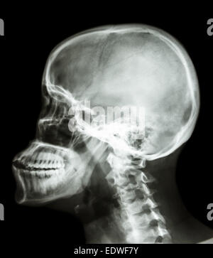 Film x-ray laterale del cranio : prova di umana del cranio e della colonna cervicale Foto Stock