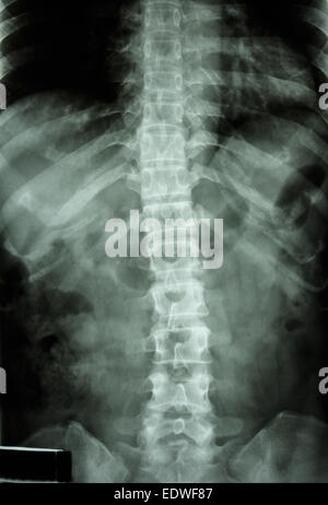 Film x-ray T-L(rachide dorso Thoracic-Lumbar) show : normale della umana toraco-lombare della colonna vertebrale Foto Stock