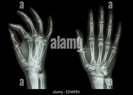 Film x-ray mano AP/obliquo : mostra umano normale la mano Foto Stock