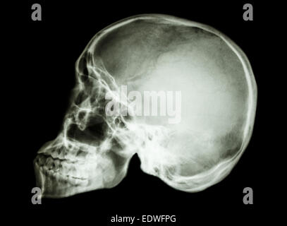 Film x-ray laterale del cranio : mostra umano normale del cranio Foto Stock