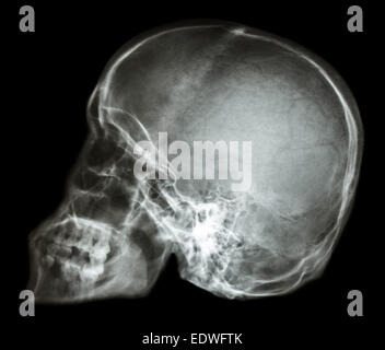 Film x-ray laterale del cranio : mostra umano normale del cranio (popolo tailandese) Foto Stock