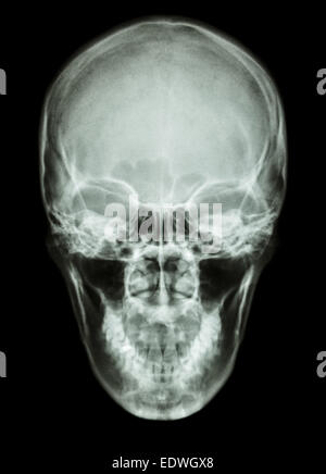 X-ray cranio asiatici (popolo tailandese) Foto Stock