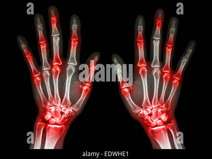 Film x-ray sia umani con le mani in mano e artrite a giunto multiplo (gotta,artrite) Foto Stock