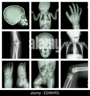 Collezione x-ray parte del corpo del bambino (versione 2) Foto Stock