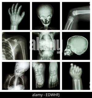 Collezione x-ray parte del corpo del bambino Foto Stock