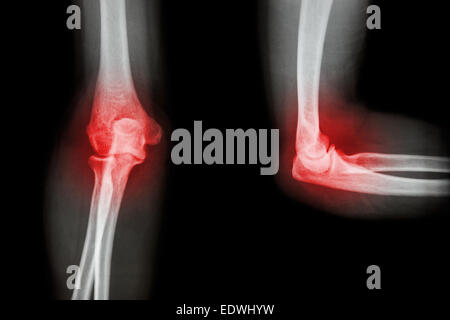 Film X-ray gomito con artrite reumatoide (,gotta) Foto Stock