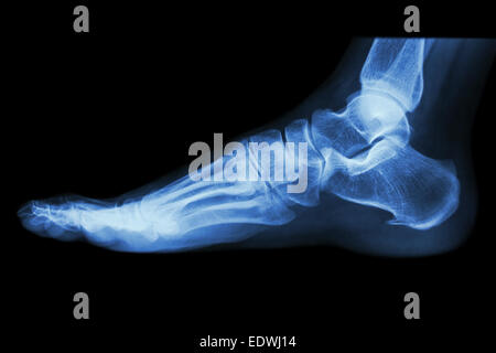 X-ray umano normale il piede laterale Foto Stock