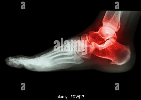 X-ray dell umano alla caviglia con artrite Foto Stock