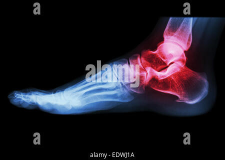 X-ray dell umano alla caviglia con artrite ( Gotta , artrite reumatoide) Foto Stock