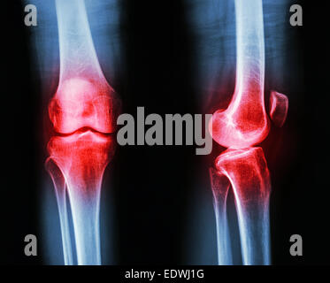 Film x-ray ginocchio AP/laterale : osteoartrite del ginocchio (infiammazione al ginocchio) Foto Stock