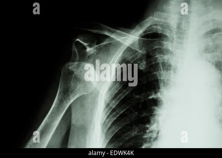 X-ray anteriore dislocazione della spalla Foto Stock