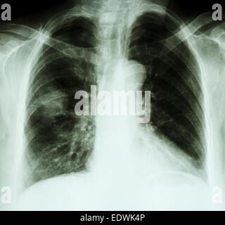 Raggi X del torace del cancro del polmone paziente(l'opacità al polmone destro) Foto Stock