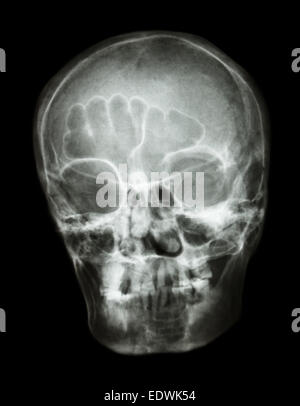 X-ray cranio(obliquo) del popolo tailandese Foto Stock